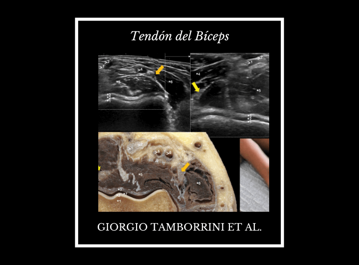 tendon-distal-del-biceps-y-ecografia